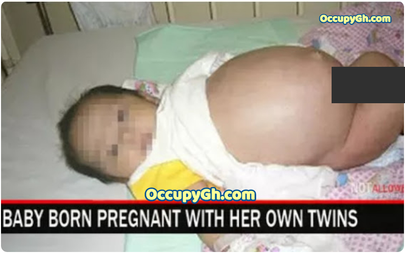 Baby Born Pregnant With Twin Brother