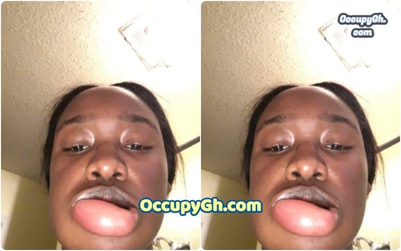 lady with swollen lips