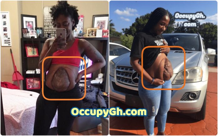 woman with intestine protruding woman with intestine protruding from stomach
