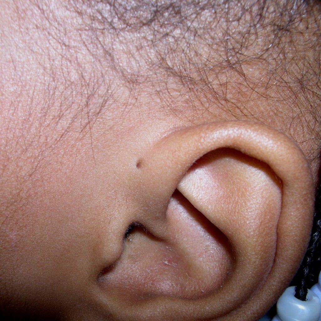Tiny Hole Above Ear
