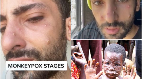 monkeypox stages