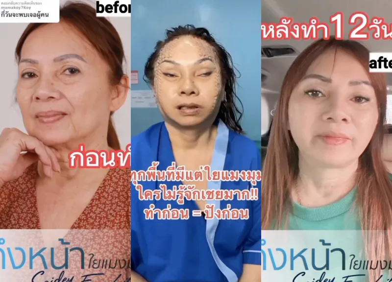 80 Yr Old Woman Undergoes Facelift Procedure To Look 30 Yrs Old   YqkSseK0 Woman Undergoes Facelift Procedure 800x576.webp