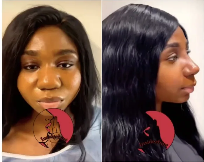 Lady Shares Before After Nose Surgery