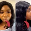 Lady Shares Before After Nose Surgery